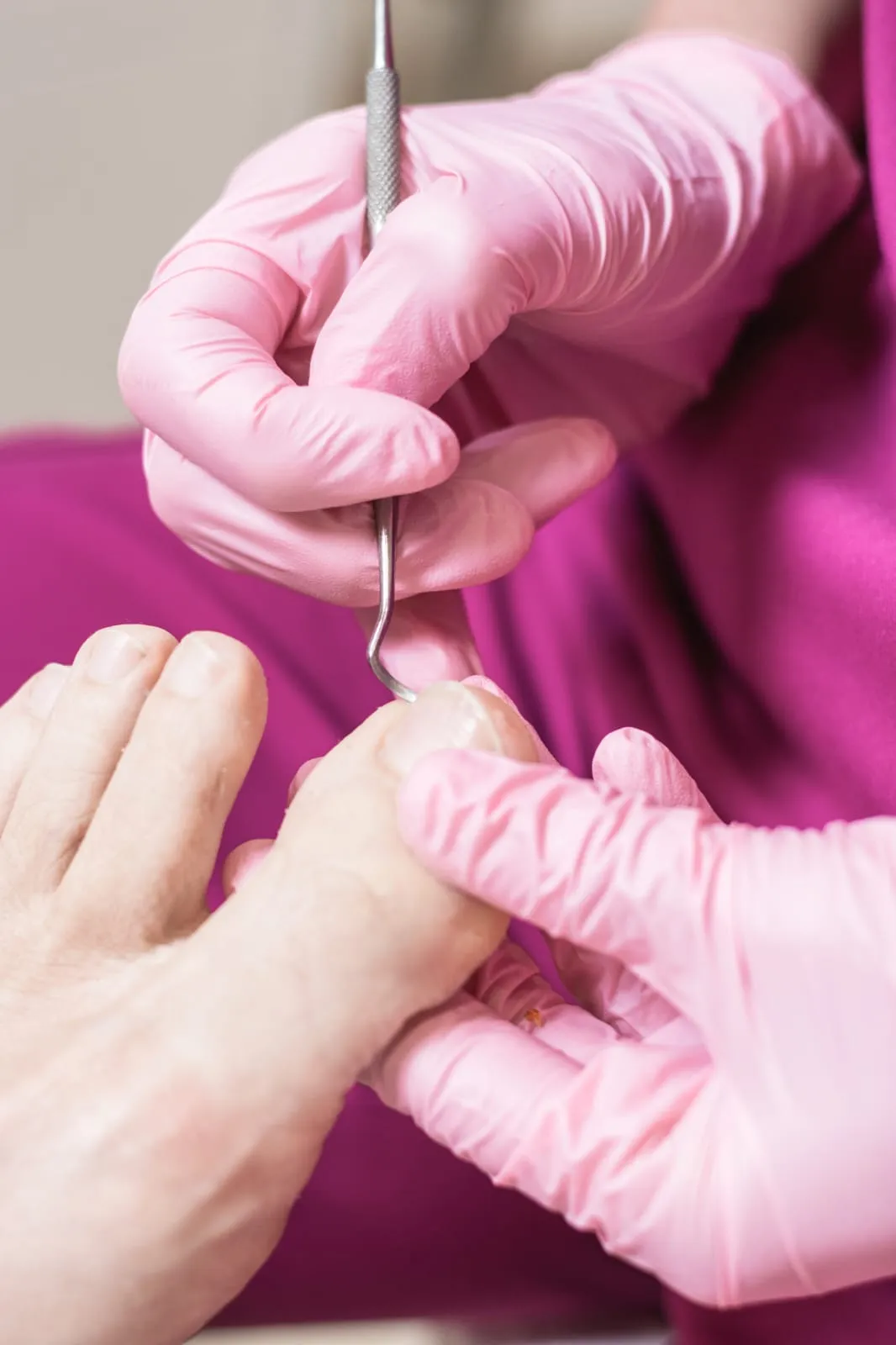 Wrastające paznokcie